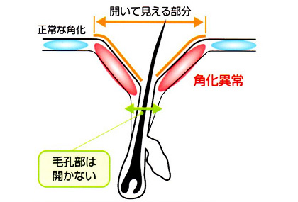 開いて目立つ毛穴