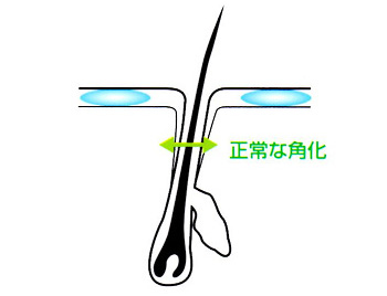 毛穴開き改善へ