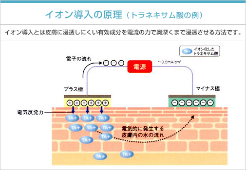 イオン導入の原理（トラネキサム酸の例）